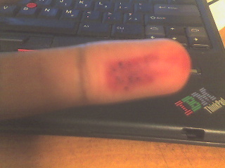My bruised left ring finger.